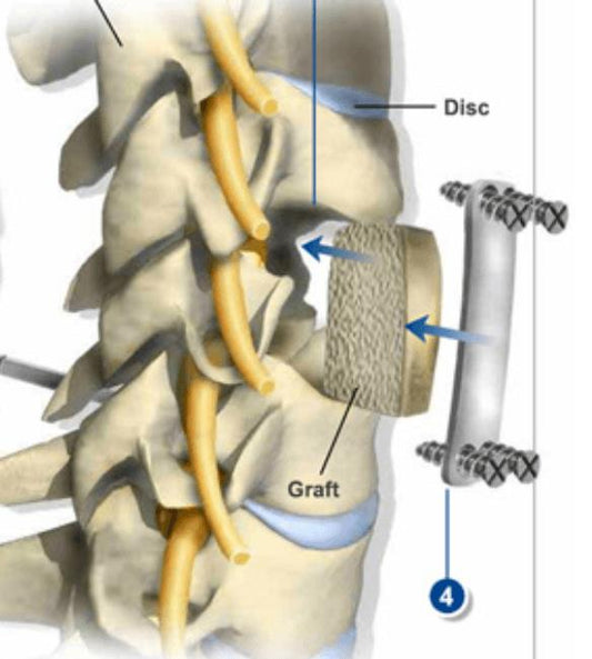 Corpectomy