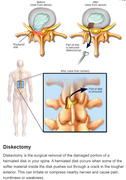 DISKECTOMY