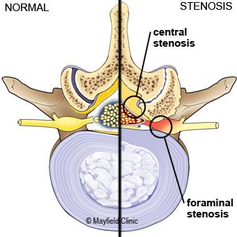 SPINAL DECOMPRESSION SURGERY