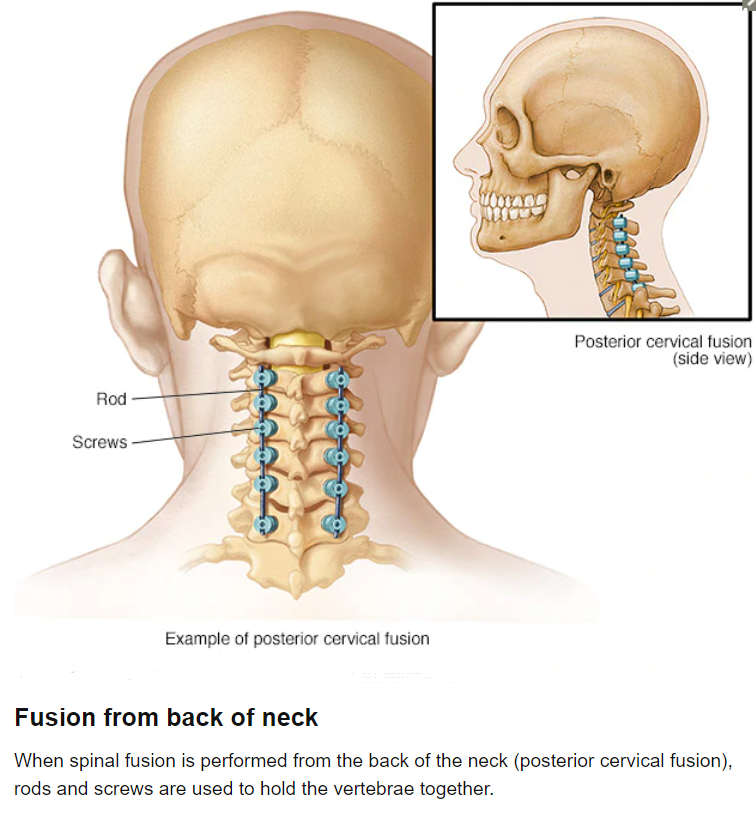 SPINAL FUSION