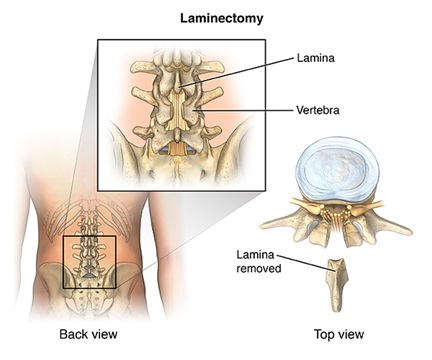 LAMINECTOMY