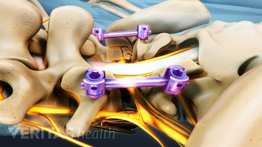 POSTERIOR LUMBAR INTERBODY FUSION